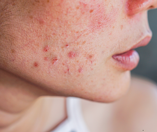 Sensitive Skin: What It Actually Means (And How to Treat It)